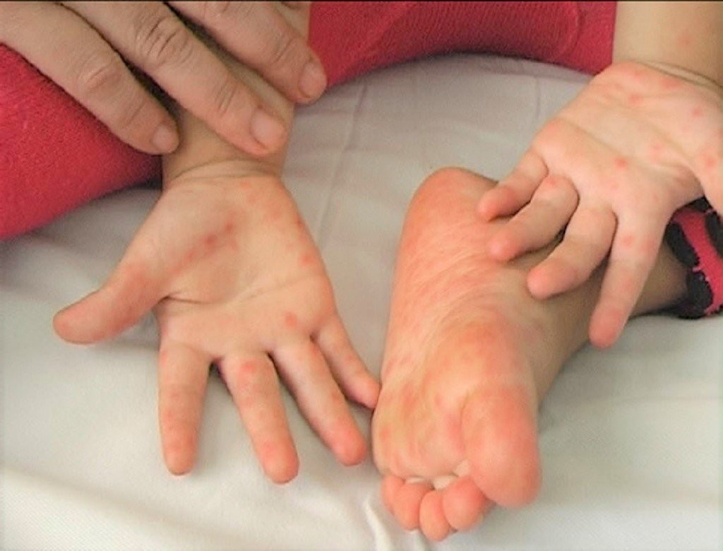 Bệnh tay chân miệng là gì? Những lưu ý về bệnh tay chân miệng bố mẹ nên biết